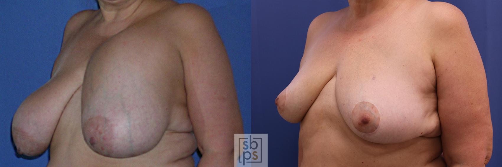 Before & After Breast Reduction Case 361 View #3 View in Torrance & Los Angeles, CA, CA