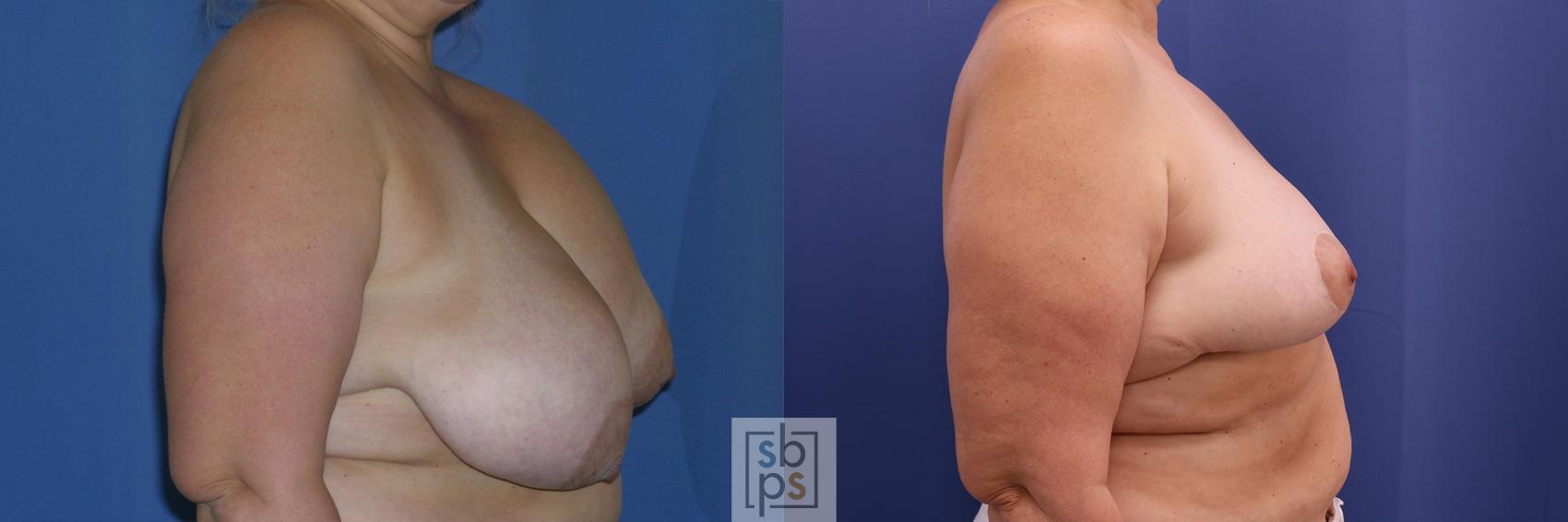 Before & After Breast Reduction Case 361 View #4 View in Torrance & Los Angeles, CA, CA