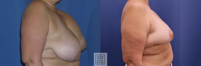 Before & After Breast Reduction Case 361 View #4 View in Torrance, CA