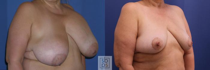Before & After Breast Reduction Case 361 View #5 View in Torrance, CA