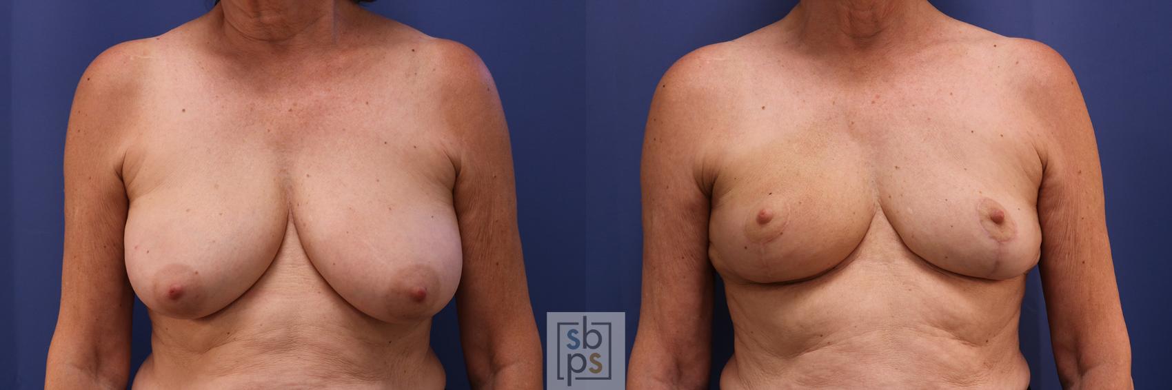 Before & After Breast Reduction Case 365 View #1 View in Torrance, CA