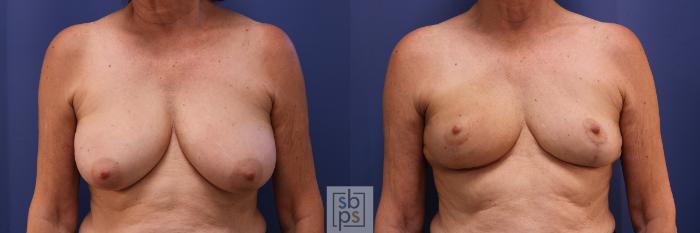 Before & After Breast Reduction Case 365 View #1 View in Torrance, CA
