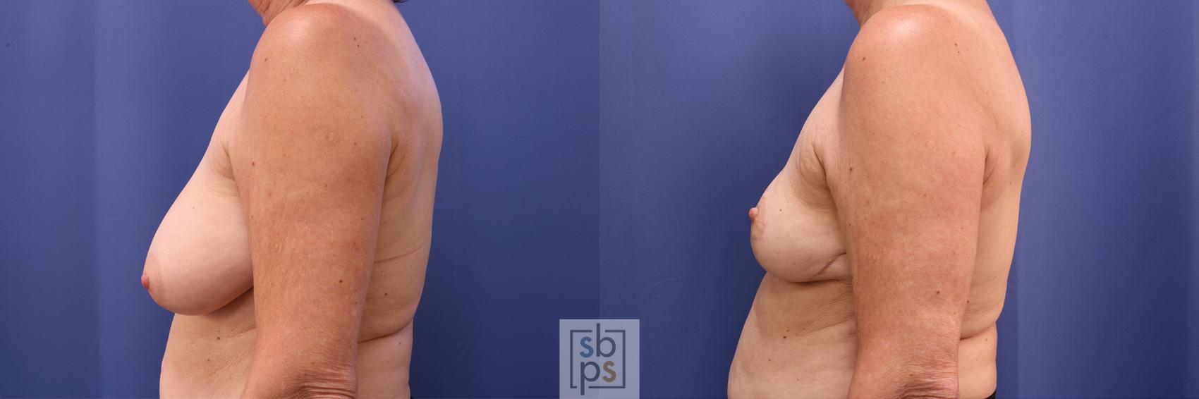 Before & After Breast Reduction Case 365 View #2 View in Torrance & Los Angeles, CA, CA