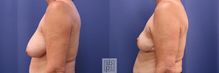 Before & After Breast Reduction Case 365 View #2 View in Torrance, CA