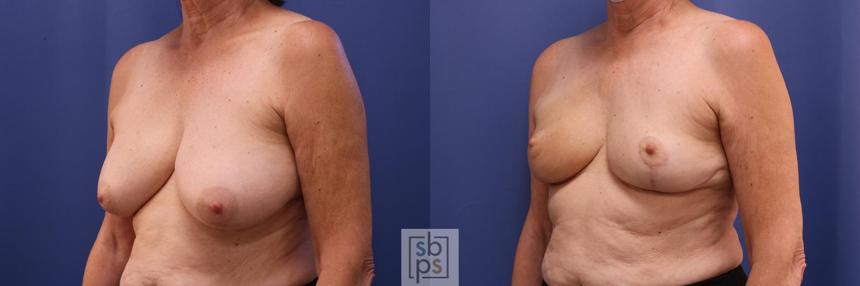 Before & After Breast Reduction Case 365 View #3 View in Torrance & Los Angeles, CA, CA