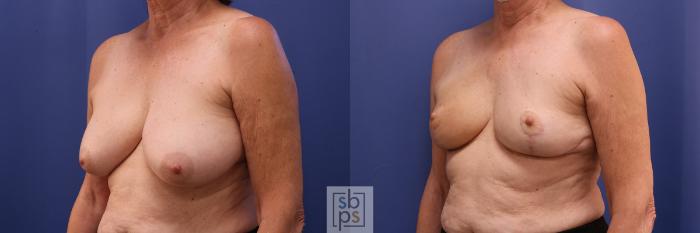 Before & After Breast Reduction Case 365 View #3 View in Torrance, CA