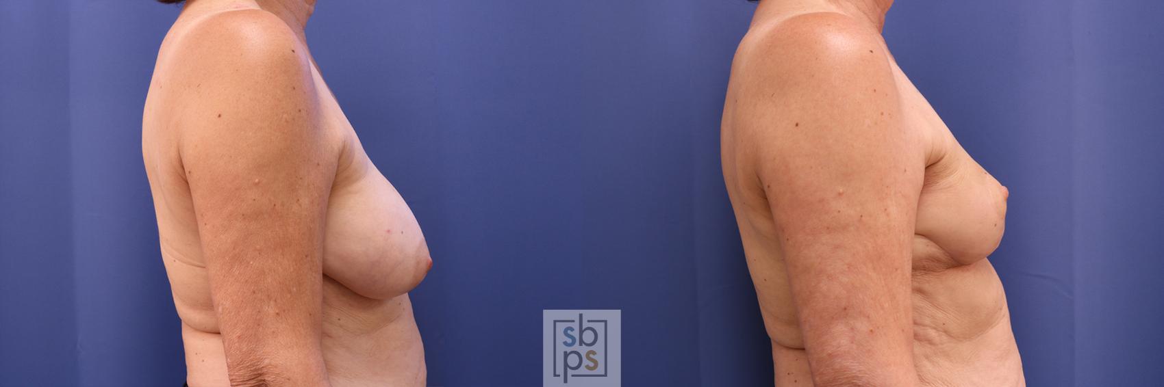 Before & After Breast Reduction Case 365 View #4 View in Torrance & Los Angeles, CA, CA