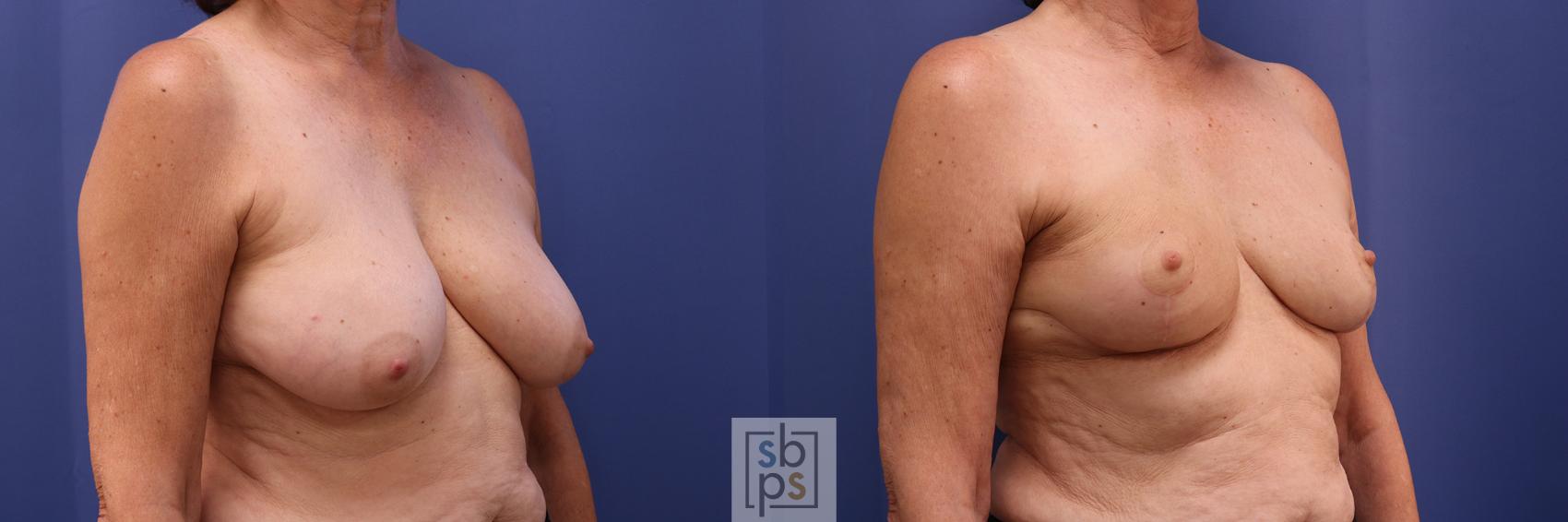 Before & After Breast Reduction Case 365 View #5 View in Torrance & Los Angeles, CA, CA