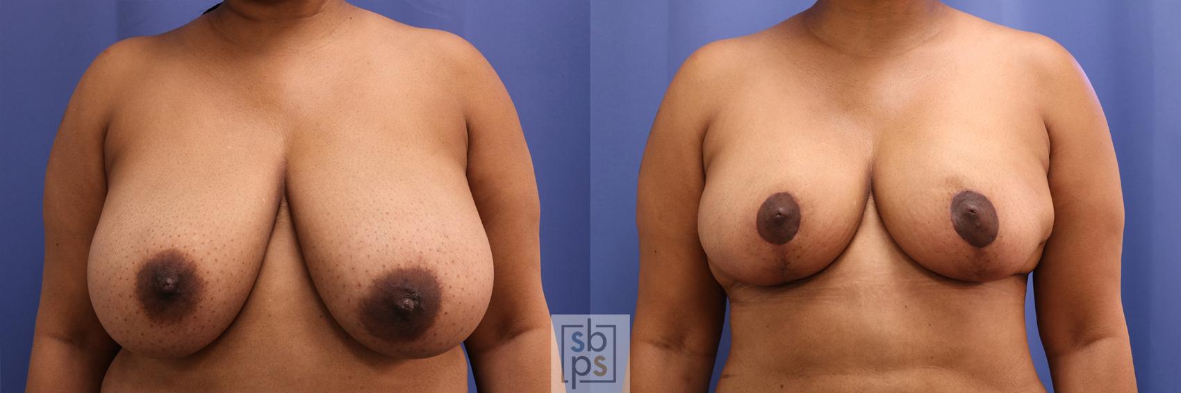 Before & After Breast Reduction Case 373 View #1 View in Torrance, CA