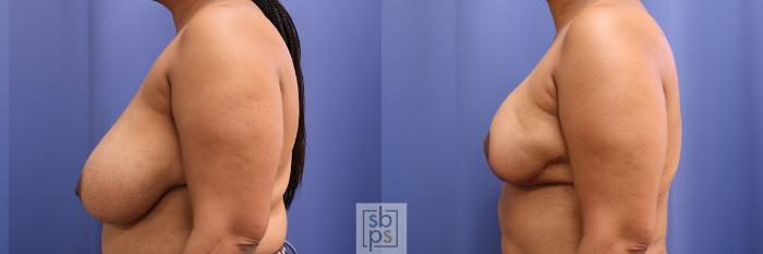 Before & After Breast Reduction Case 373 View #2 View in Torrance, CA