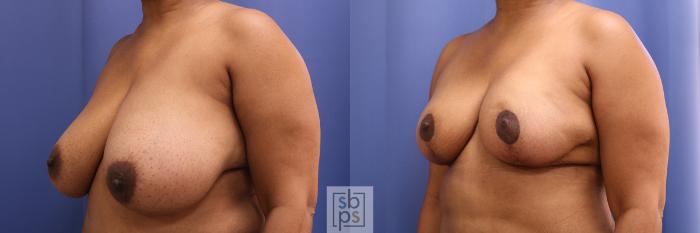 Before & After Breast Reduction Case 373 View #3 View in Torrance, CA