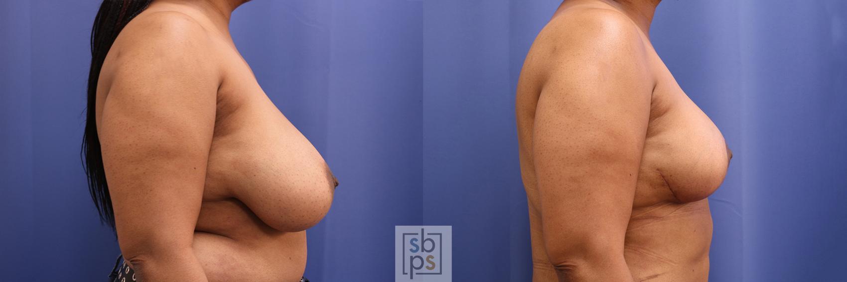 Before & After Breast Reduction Case 373 View #4 View in Torrance & Los Angeles, CA, CA