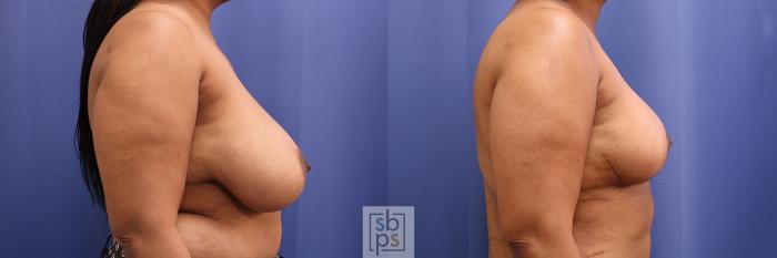 Before & After Breast Reduction Case 373 View #4 View in Torrance, CA
