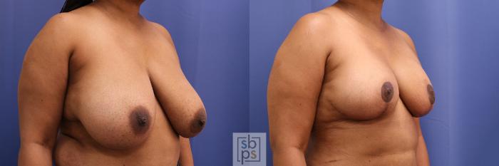 Before & After Breast Reduction Case 373 View #5 View in Torrance, CA