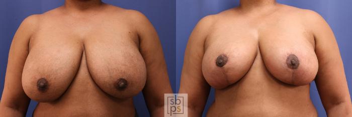 Before & After Breast Reduction Case 386 Front View in Torrance, CA