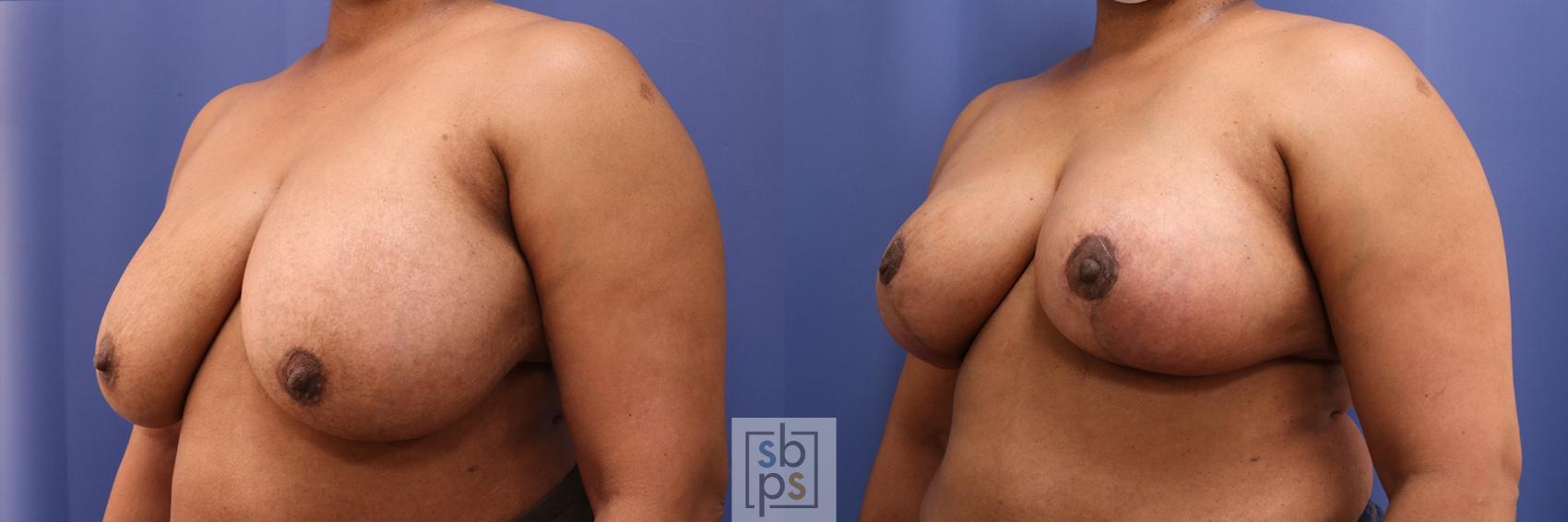 Before & After Breast Reduction Case 386 Left Oblique View in Torrance & Los Angeles, CA, CA