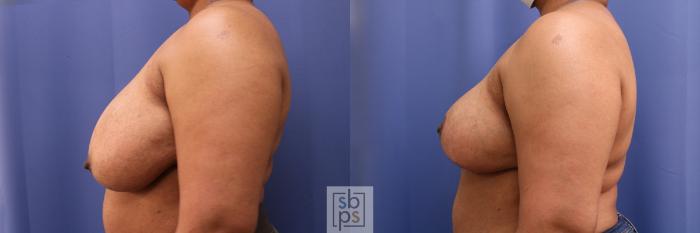 Before & After Breast Reduction Case 386 Left Side View in Torrance, CA