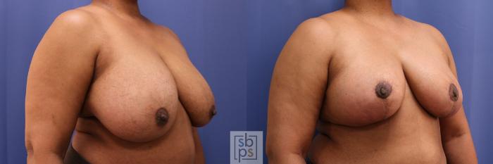 Before & After Breast Reduction Case 386 Right Oblique View in Torrance, CA