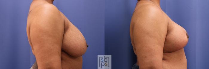 Before & After Breast Reduction Case 386 Right Side View in Torrance, CA