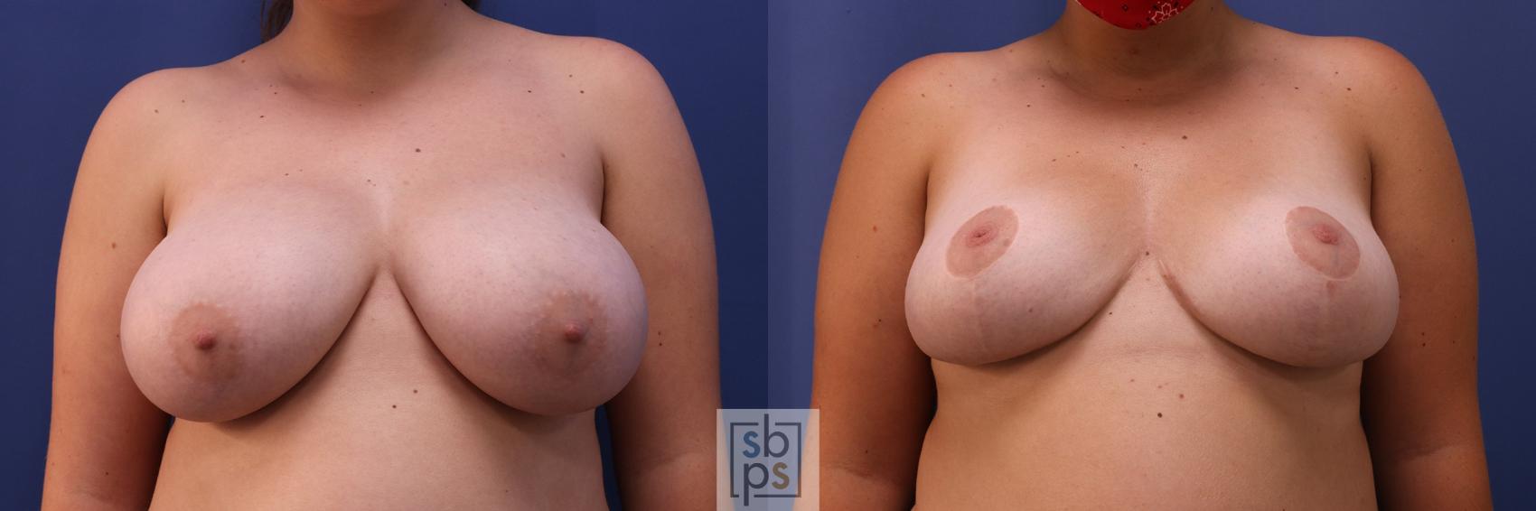 Before & After Breast Reduction Case 387 Front View in Torrance, CA