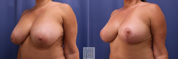Before & After Breast Reduction Case 399 Left Oblique View in Torrance, CA