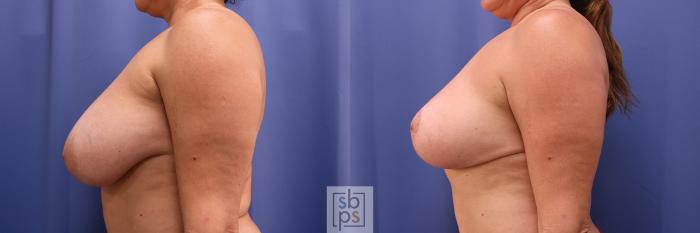 Before & After Breast Reduction Case 399 Left Side View in Torrance, CA