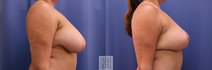 Before & After Breast Reduction Case 399 Right Side View in Torrance, CA