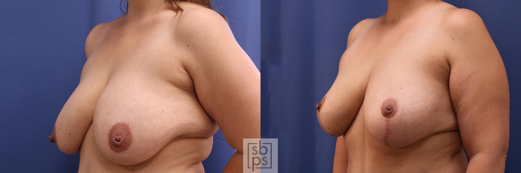 Before & After Breast Reduction Case 403 Left Oblique View in Torrance & Los Angeles, CA, CA