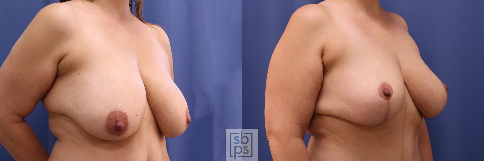 Before & After Breast Reduction Case 403 Right Oblique View in Torrance & Los Angeles, CA, CA