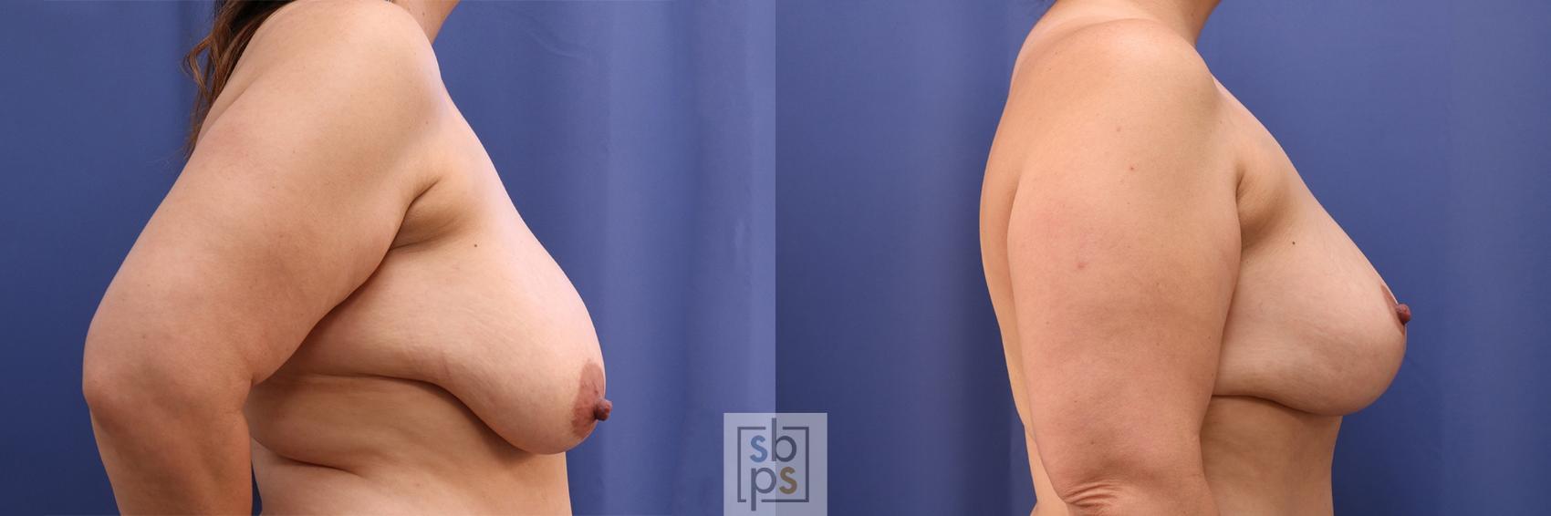 Before & After Breast Reduction Case 403 Right Side View in Torrance & Los Angeles, CA, CA