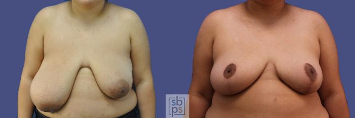 Before & After Breast Reduction Case 410 Front View in Torrance, CA