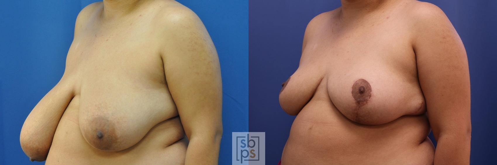 Before & After Breast Reduction Case 410 Left Oblique View in Torrance & Los Angeles, CA, CA