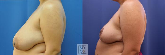 Before & After Breast Reduction Case 410 Left Side View in Torrance, CA