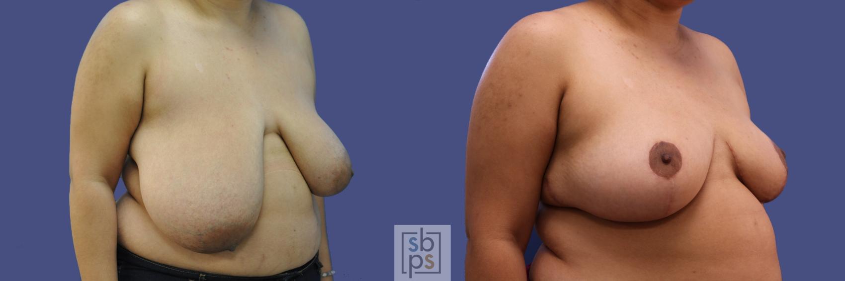 Before & After Breast Reduction Case 410 Right Oblique View in Torrance & Los Angeles, CA, CA