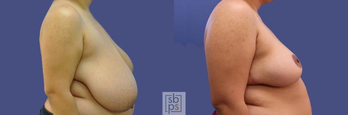 Before & After Breast Reduction Case 410 Right Side View in Torrance, CA