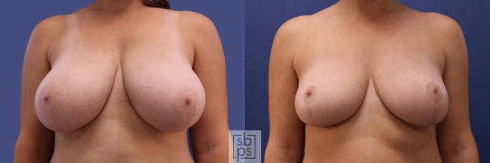 Before & After Breast Reduction Case 412 Front View in Torrance, CA