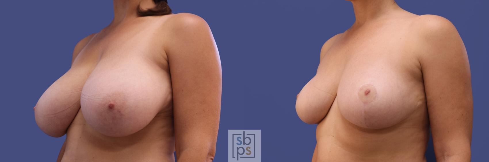Before & After Breast Reduction Case 412 Left Oblique View in Torrance & Los Angeles, CA, CA