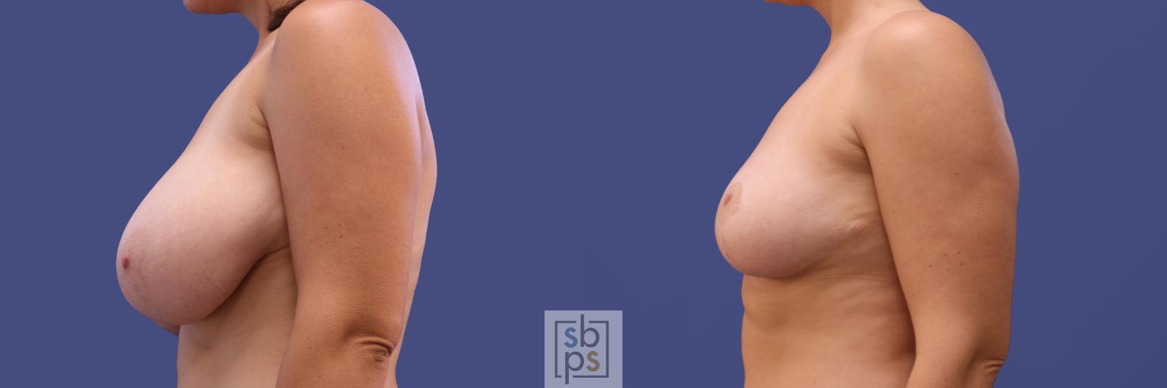 Before & After Breast Reduction Case 412 Left Side View in Torrance & Los Angeles, CA, CA