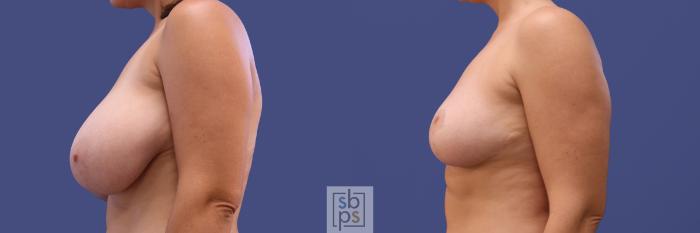 Before & After Breast Reduction Case 412 Left Side View in Torrance, CA