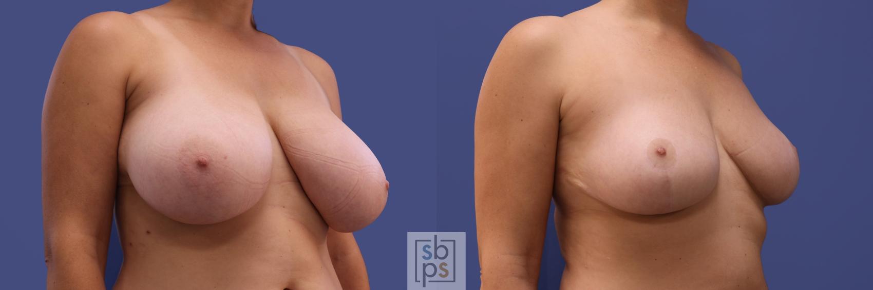 Before & After Breast Reduction Case 412 Right Oblique View in Torrance & Los Angeles, CA, CA