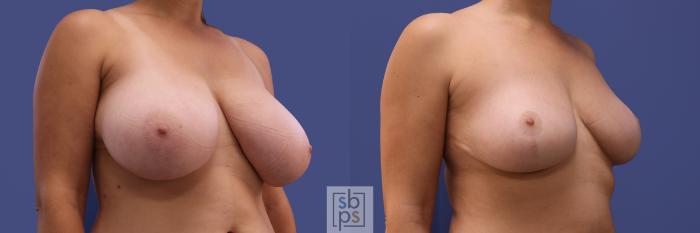 Before & After Breast Reduction Case 412 Right Oblique View in Torrance, CA