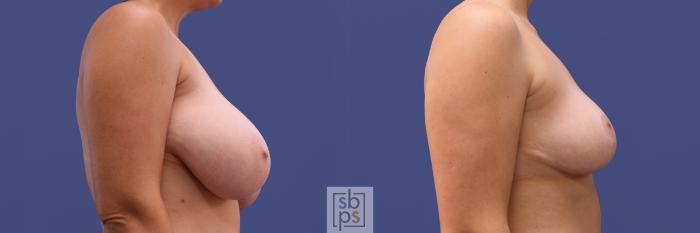 Before & After Breast Reduction Case 412 Right Side View in Torrance, CA
