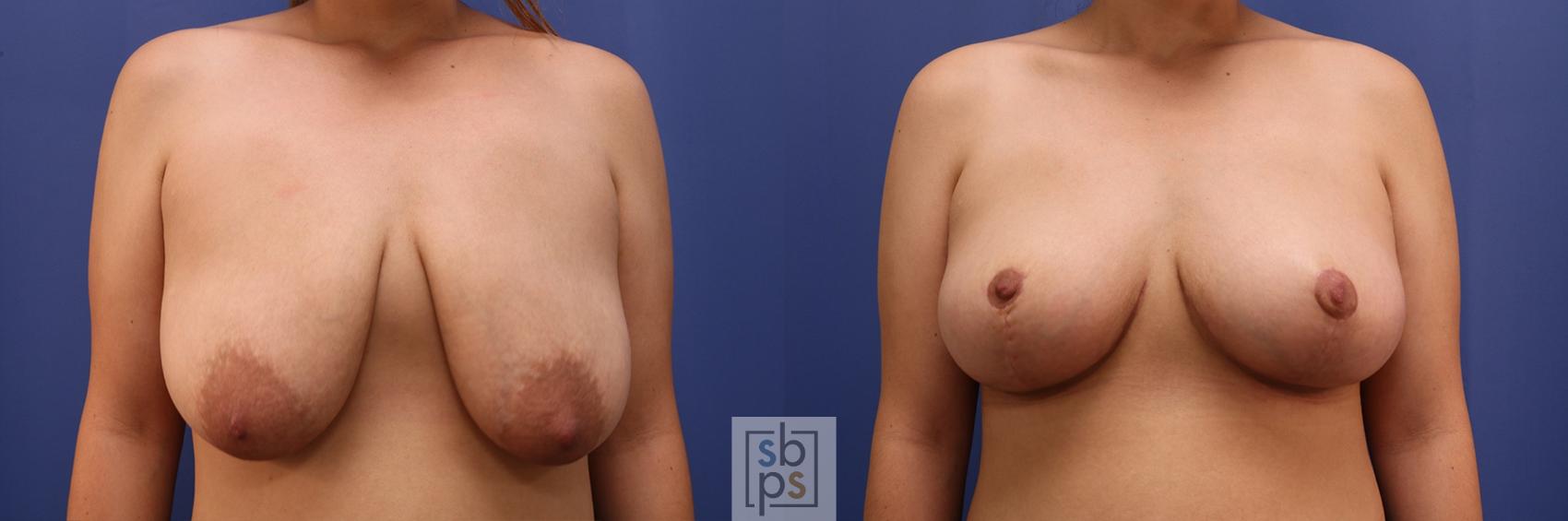 Before & After Breast Reduction Case 414 Front View in Torrance, CA