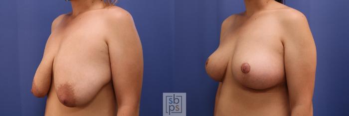 Before & After Breast Reduction Case 414 Left Oblique View in Torrance, CA