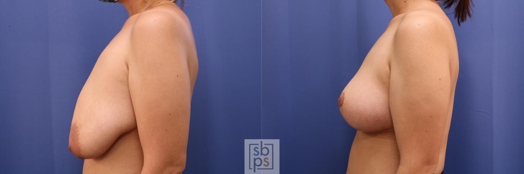 Before & After Breast Reduction Case 414 Left Side View in Torrance & Los Angeles, CA, CA