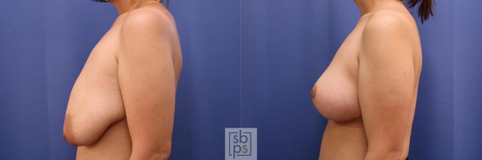 Before & After Breast Reduction Case 414 Left Side View in Torrance, CA