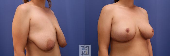 Before & After Breast Reduction Case 414 Right Oblique View in Torrance, CA