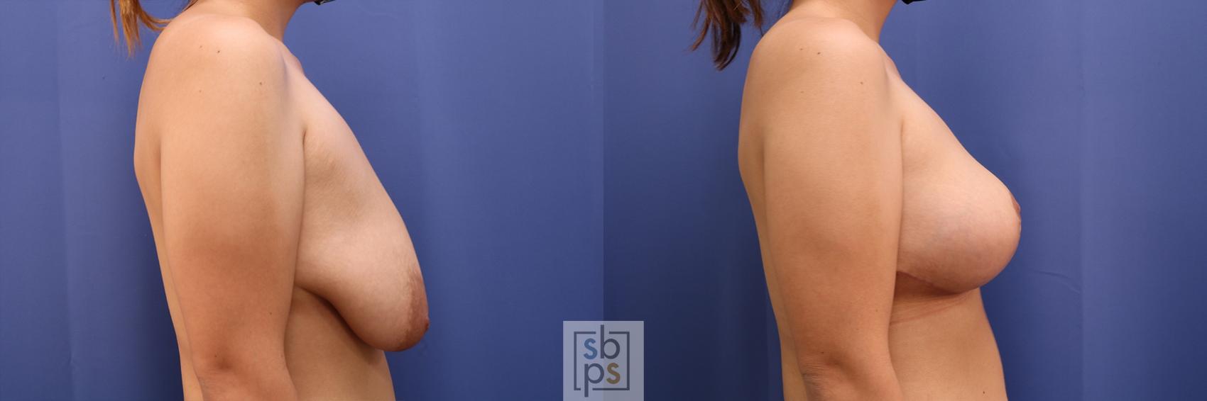Before & After Breast Reduction Case 414 Right Side View in Torrance & Los Angeles, CA, CA