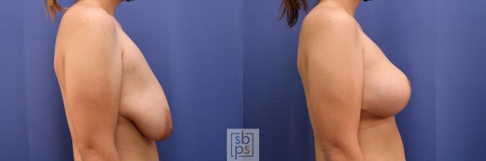 Before & After Breast Reduction Case 414 Right Side View in Torrance, CA