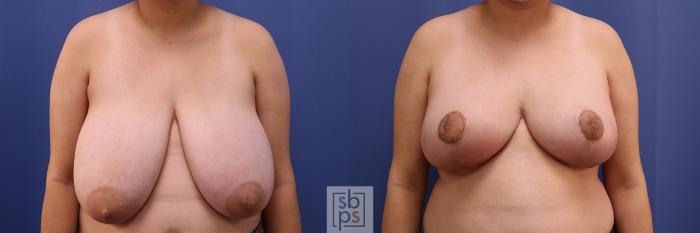 Before & After Breast Reduction Case 417 Front View in Torrance, CA